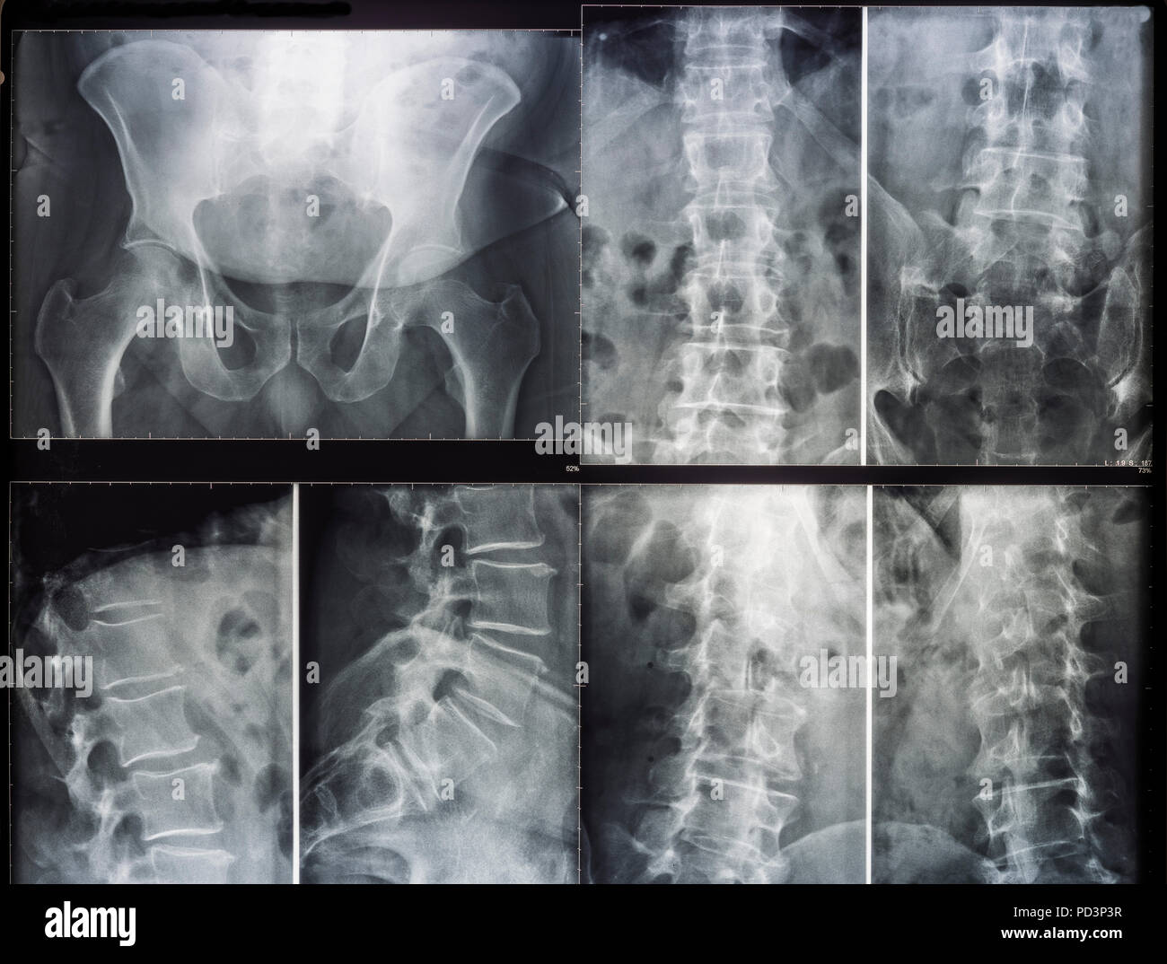 X-ray pictures of a human pelvis and spinal column Stock Photo