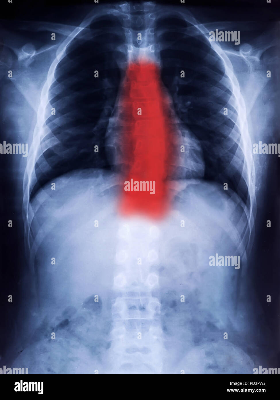 X-Ray Film of Human Spine Scoliosis for Medical Diagnosis Stock Photo
