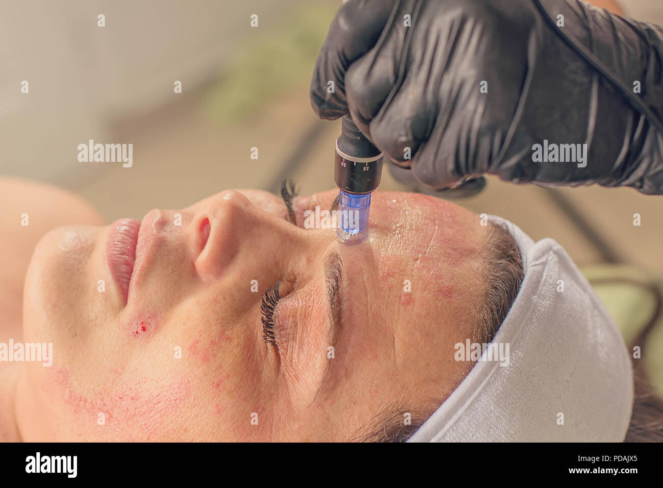 Mesotherapy needle hires stock photography and images Alamy