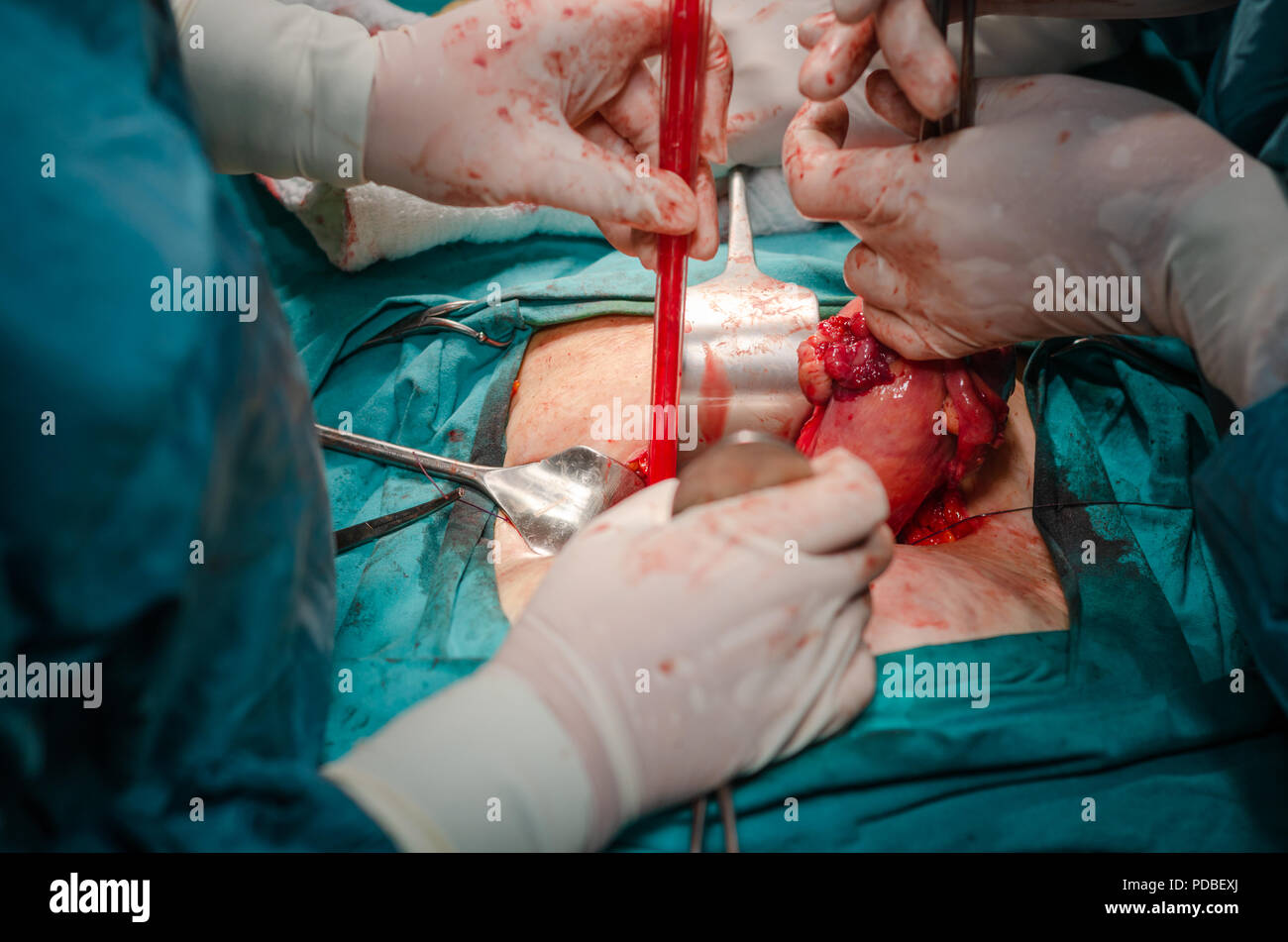 Surgeon pulls uterus out of the body holding by surgical tools close-up during the hysterectomy surgery Stock Photo