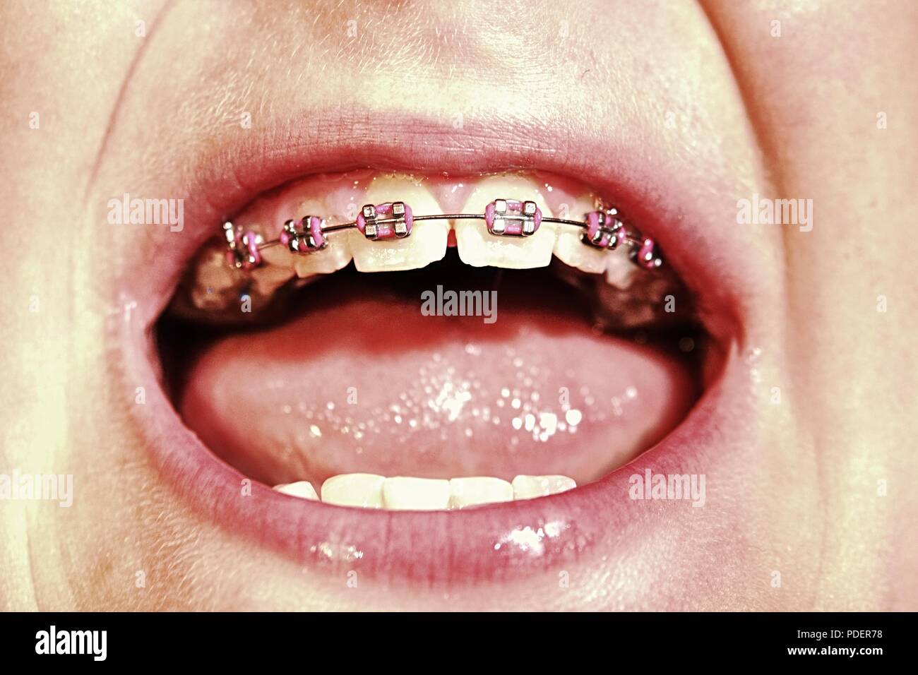 Dental braces in a young boy mouth. Teen with braces on his teeth