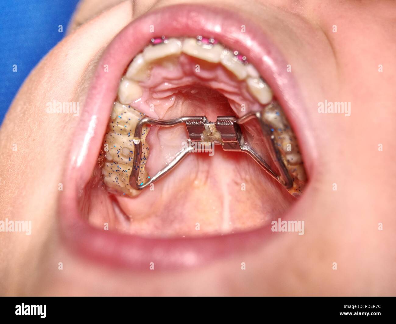 Dental braces in a young boy mouth. Teen with braces on his teeth