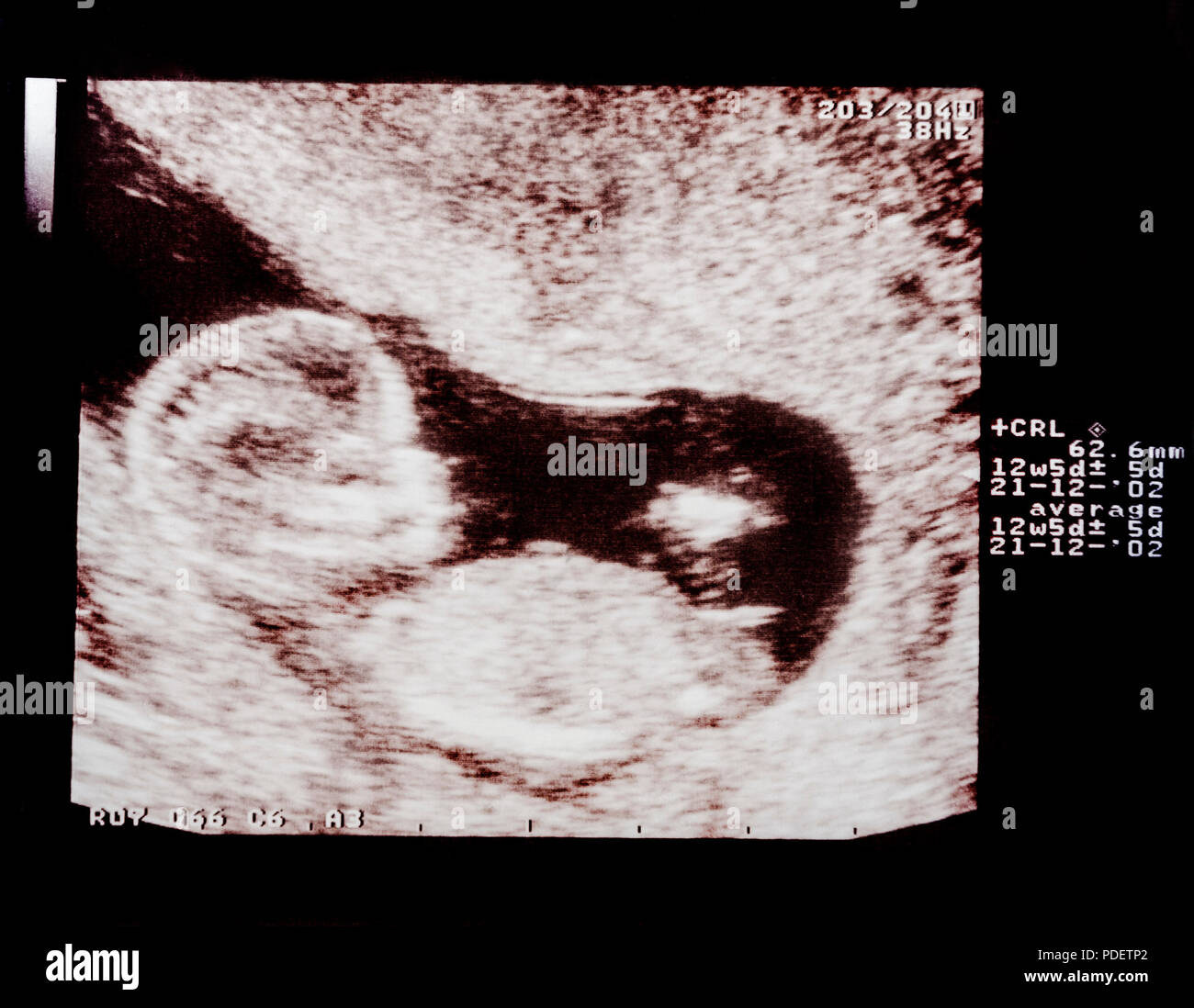 First trimester antenatal ultrasound scan at 3 month pregnancy health check up Stock Photo