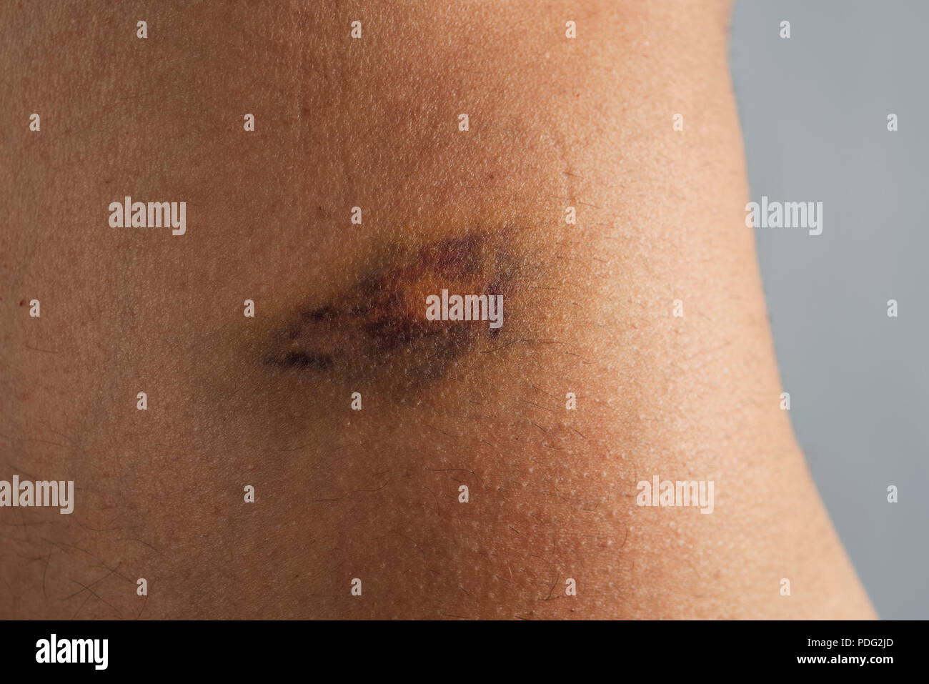 closeup of the flank of a caucasian man with a hematoma Stock Photo