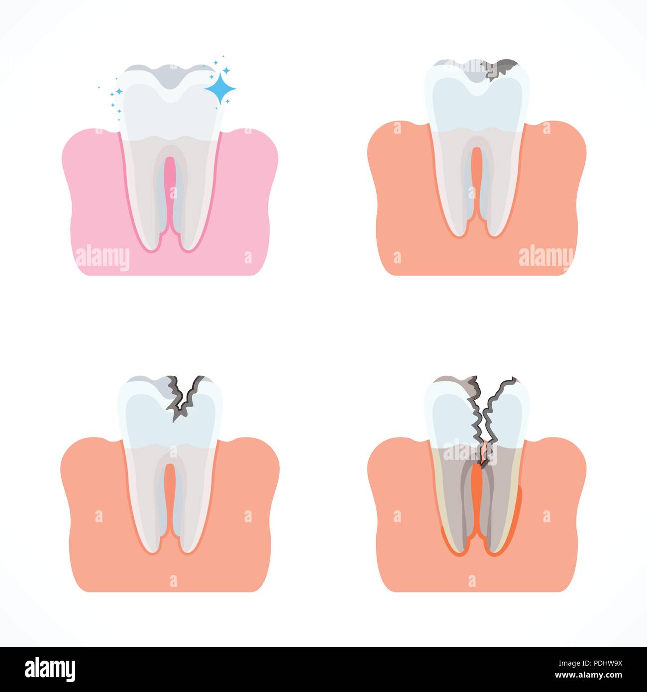 Stages of tooth decay with caries. Dentistry and oral care Stock Vector