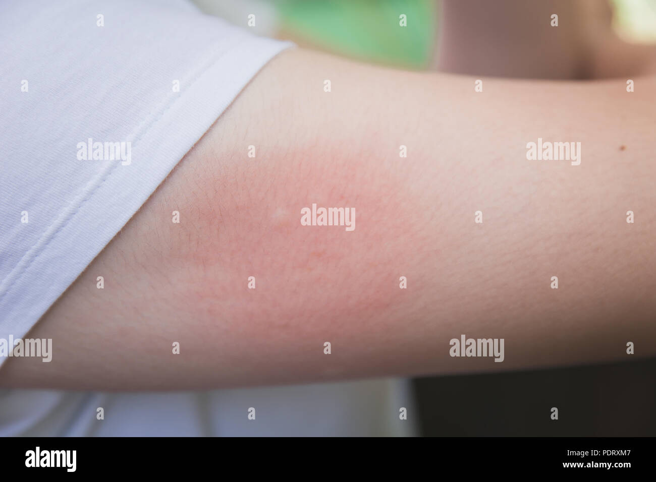 irritation skin allergy by mosquitoes insect bite or sting red