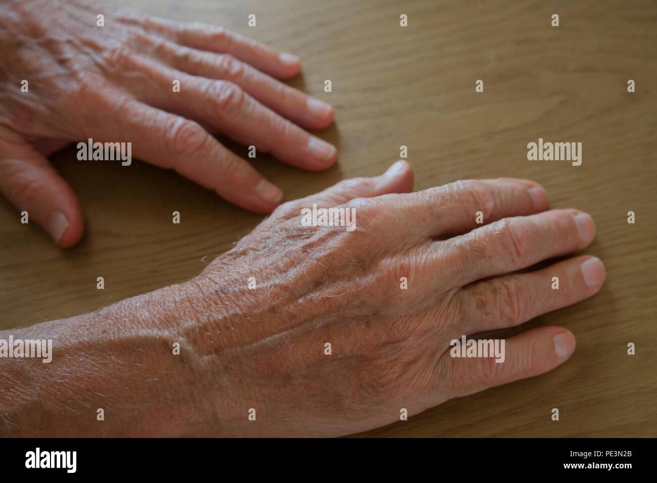 Liver Spots Hands High Resolution Stock Photography And Images Alamy Liver Spots Hands High Resolution Stock Photography And Images Alamy