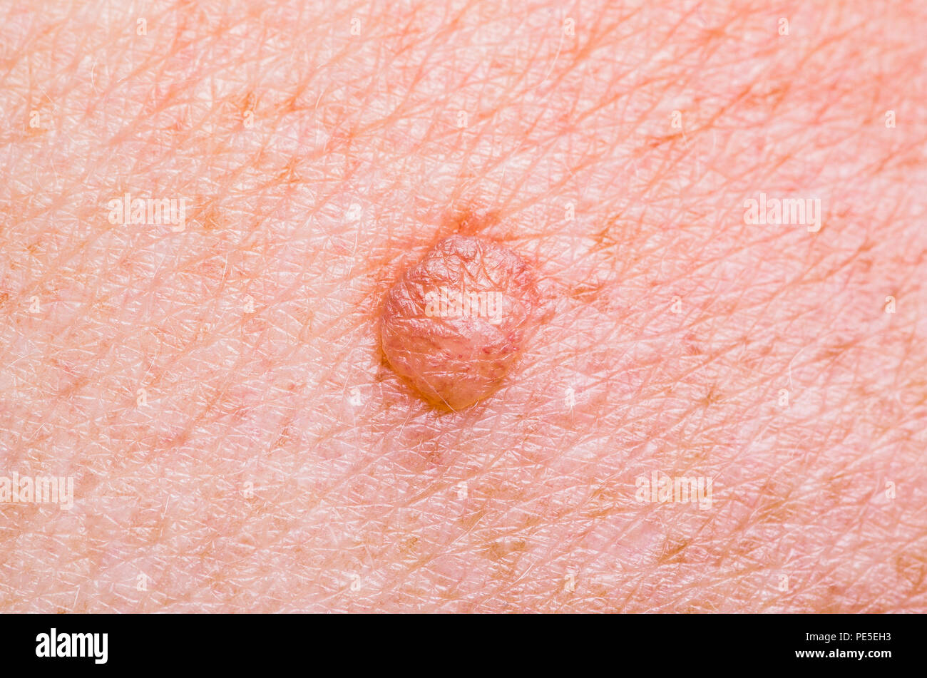 Skin Mole Defect High Magnification Macro Photo for Medical Diagnosis Stock Photo