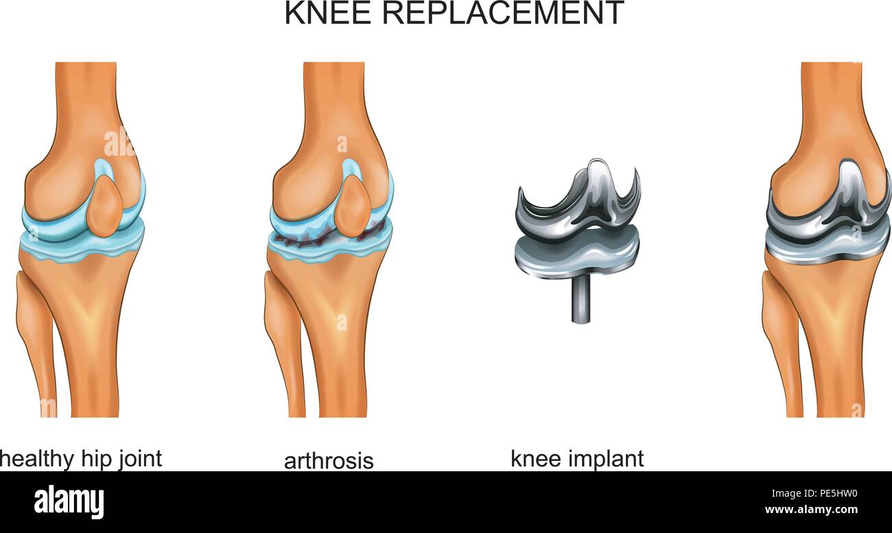 vector illustration of a total knee replacement Stock Vector