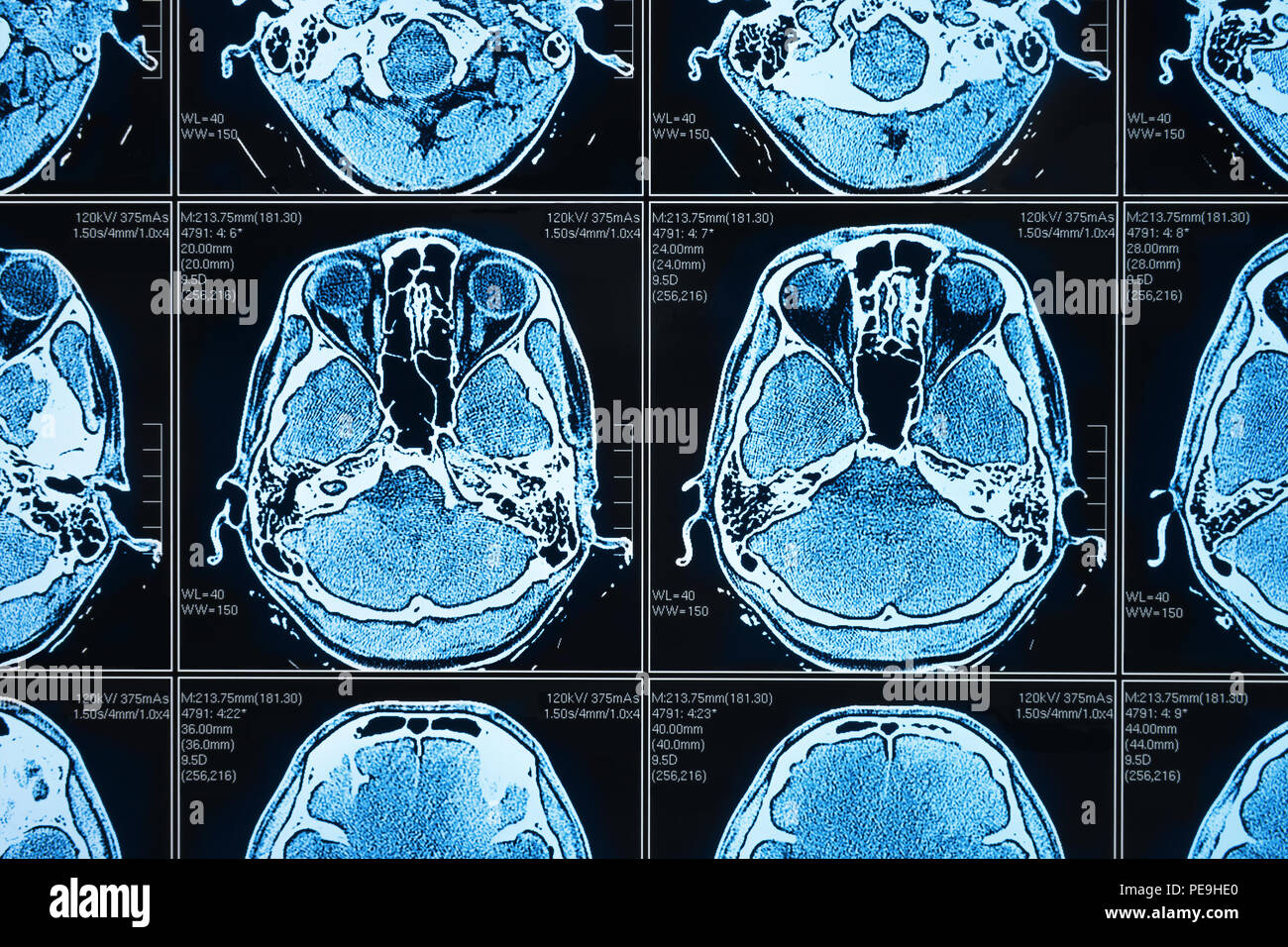 Artificial intelligence in smart healthcare hospital technology concept. AI biomedical algorithm and machine learning detect brain Pneumonia and cance Stock Photo