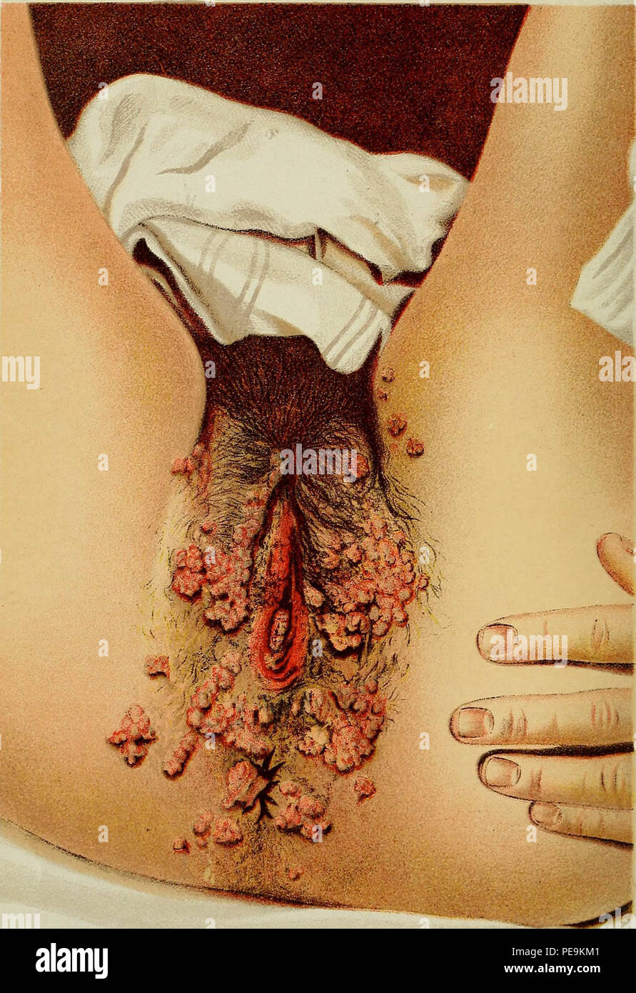 diseases of the anus Mother fucker cocktail