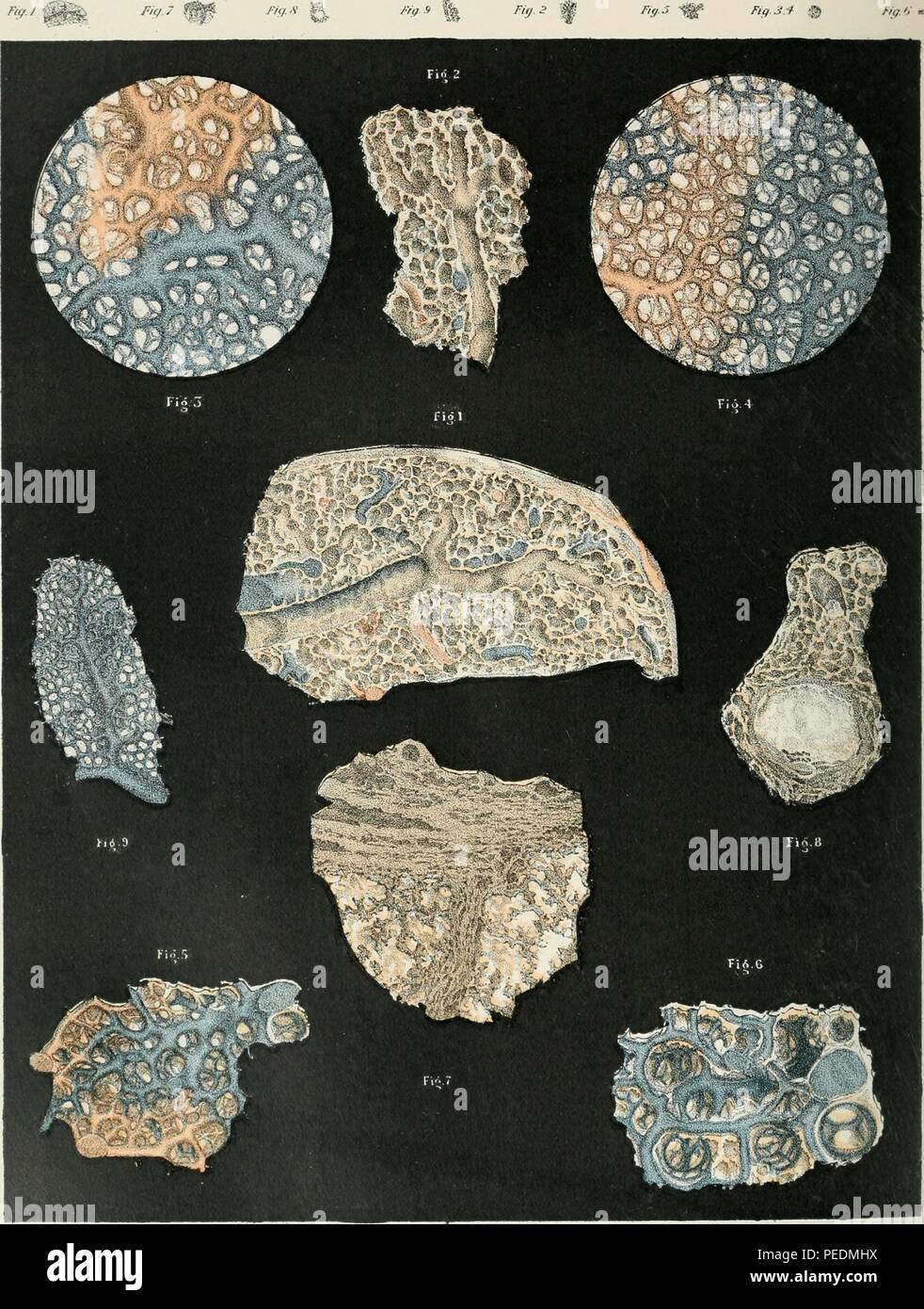 Color image of nine sections of lung tissues infected with tuberculosis, showing gradual metamorphoses of parenchyma during progressive caseation of the tissues, leading to the destruction of the vascular supply, 1901. Courtesy Internet Archive. () Stock Photo