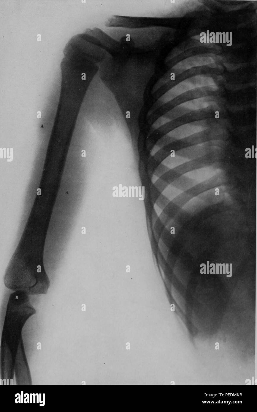 Black and white X-ray or Rontgen ray illustrating cellulitis of tissues of the left arm, following subcutaneous injection, in a nine-year-old male, 1910. Courtesy Internet Archive. () Stock Photo