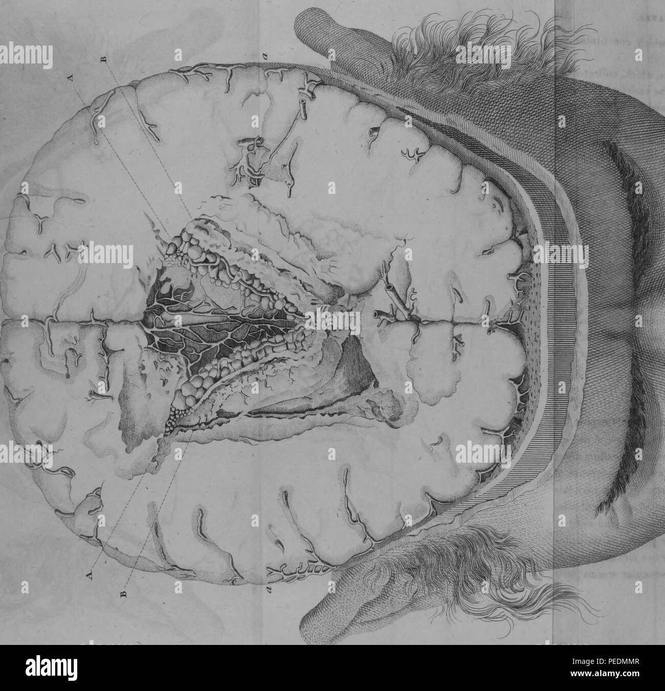 Black and white print illustrating a cross-section of the lateral ventricles of a human brain, with alphabetized figures indicating the sites of ventricular worm infestations, 1825. Courtesy Internet Archive. () Stock Photo