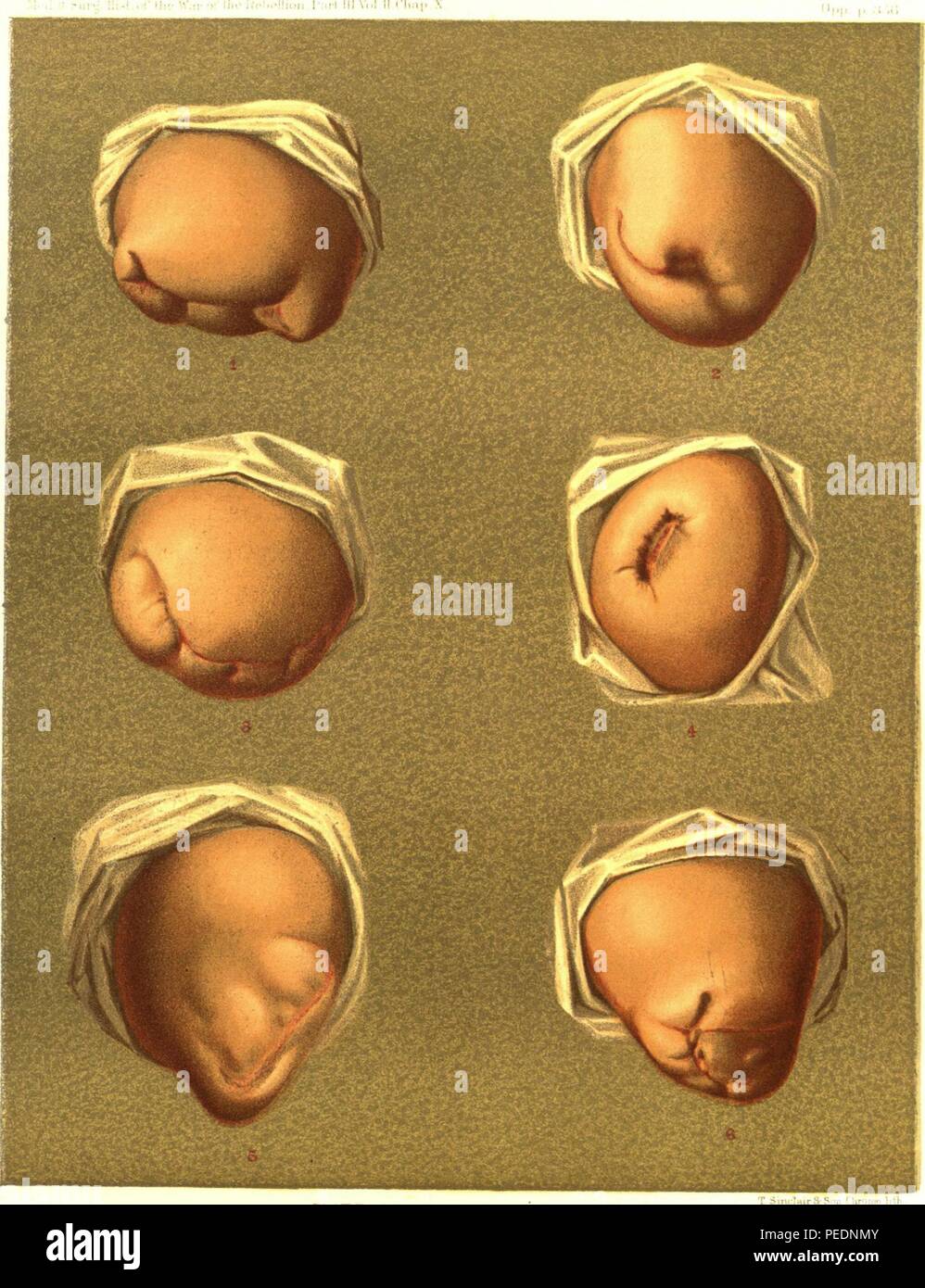 Color print depicting six images of the stumps remaining after human thighs were amputated, numbered 1-6 to indicate the amputation style, by anterior flap, posterior flap, anterior-posterior flaps, circular flaps, lateral flaps, and by flap of skin and circular muscles respectively, published in 'The Medical and Surgical History of the War of the Rebellion Part III, Volume II (3rd Surgical volume)', 1883. Courtesy Internet Archive. () Stock Photo