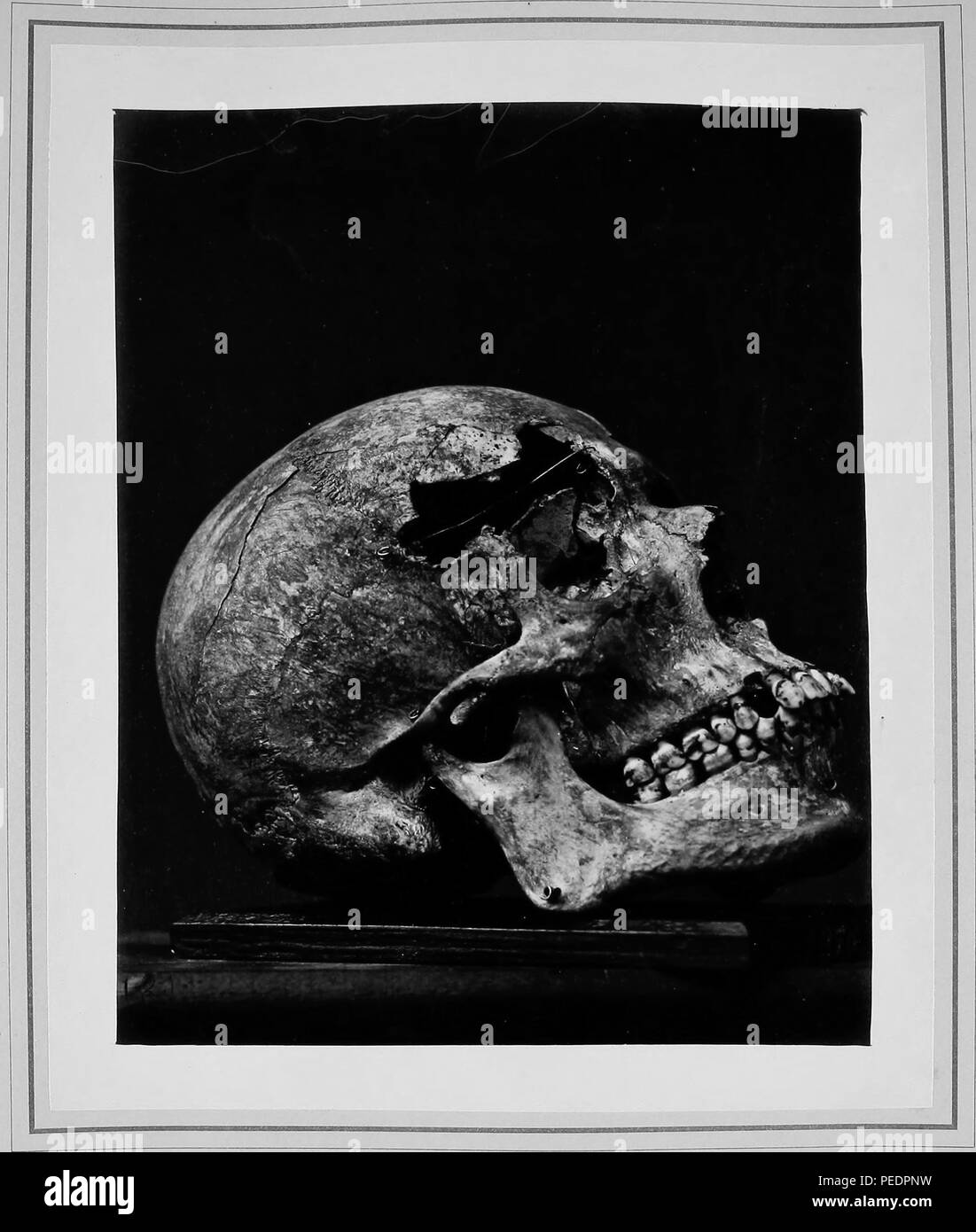 Black and white photograph showing the fractured cranium of Private Edward Volk, who was wounded August 30, 1862, at the second battle of Bull Run, by a musket ball, which struck his forehead half an inch above the right eyebrow, 1865. Courtesy Internet Archive. () Stock Photo