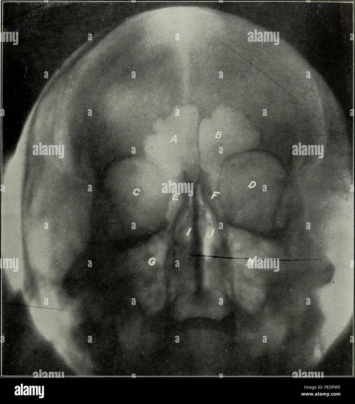 Black and white, early twentieth-century dental radiograph, with letters labeling the frontal and ethmoid sinuses, orbits, and nasal cavity, 1825. Courtesy Internet Archive. () Stock Photo