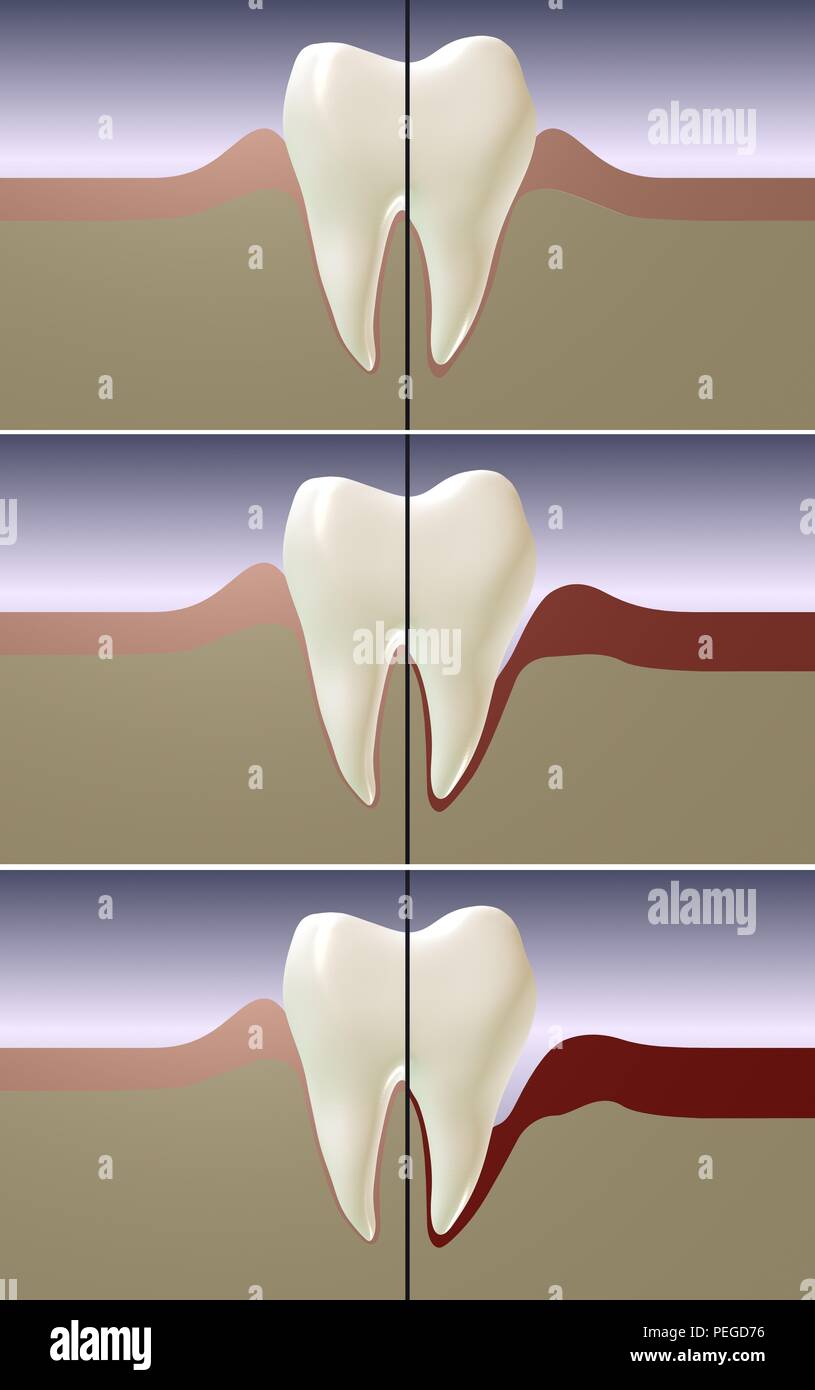 Periodontal disease, gingivitis and gum inflammation 3d rendering illustration. Dental care. Stock Photo