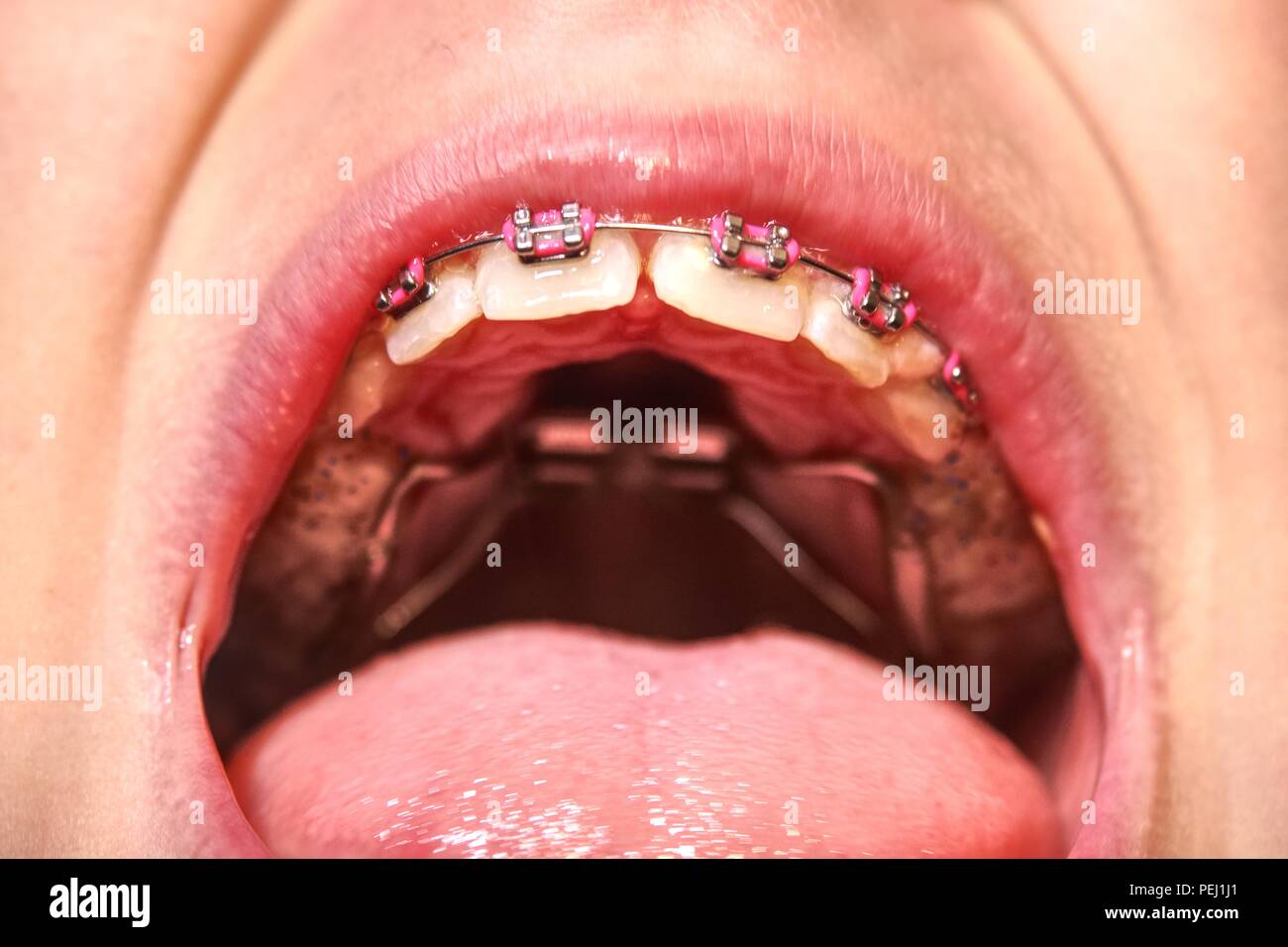 Dental braces in a young boy mouth. Teen with braces on his teeth