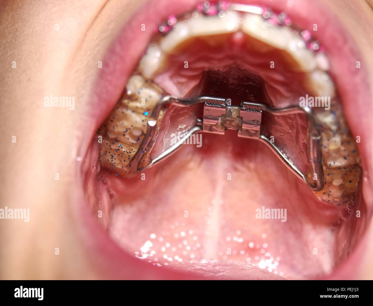 Kid wearing orthodontic palatal expanding trainer. Invisible braces aligner. Popular orthodontic appliance for birth dental deffect Stock Photo