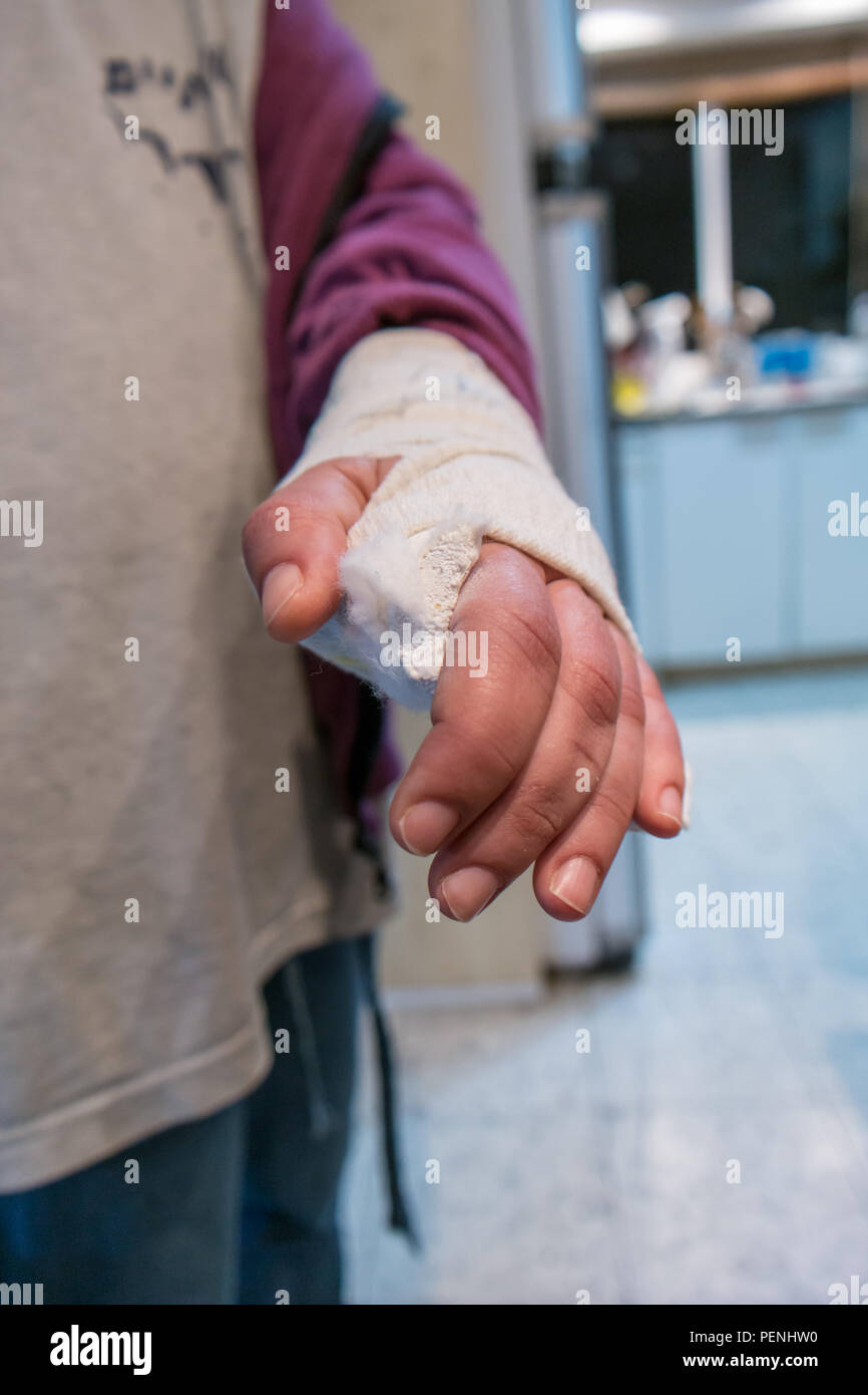 Broken arm bone in cast Stock Photo Alamy