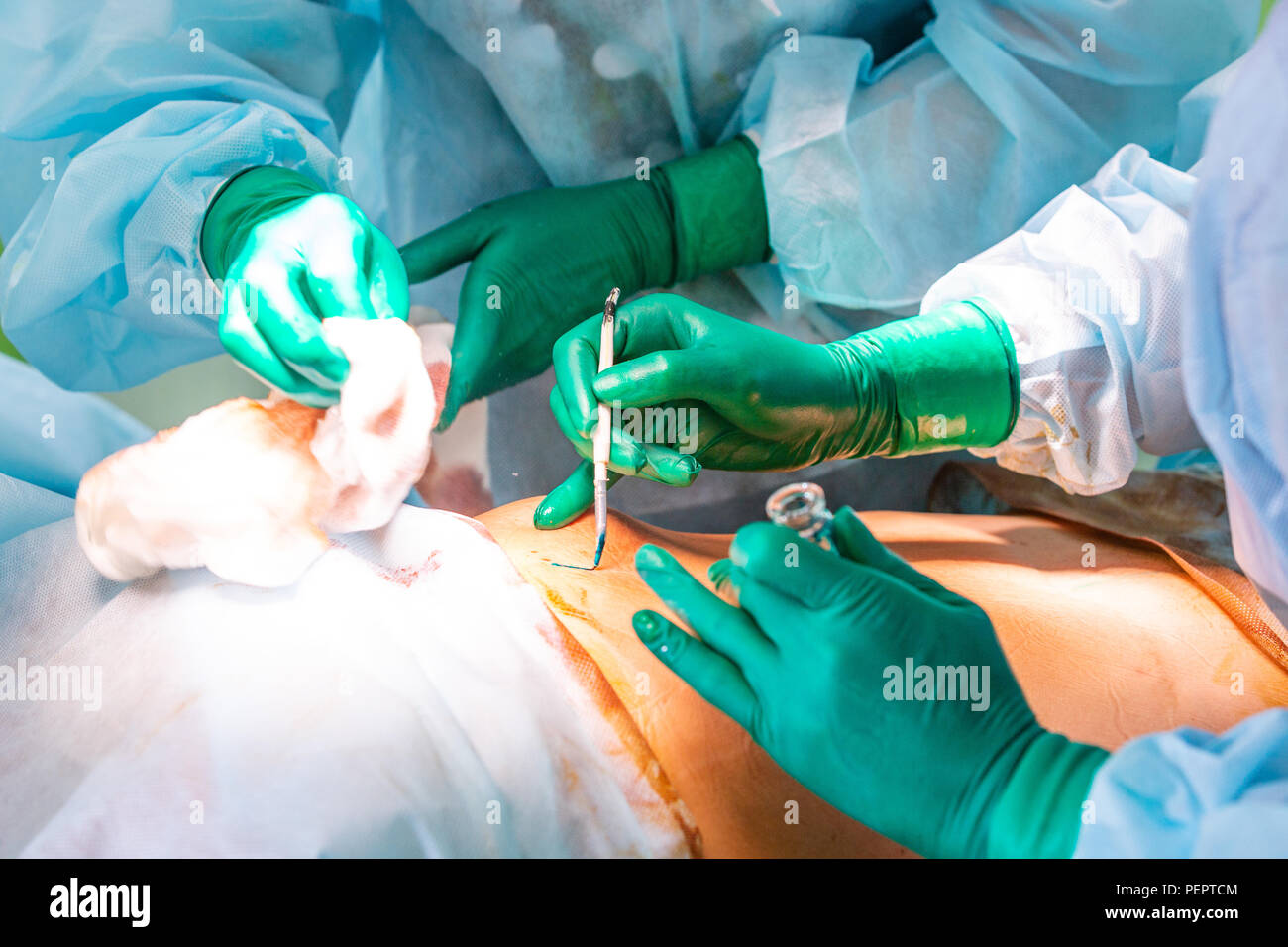 cosmetic liposuction surgery in actual operating room, group of