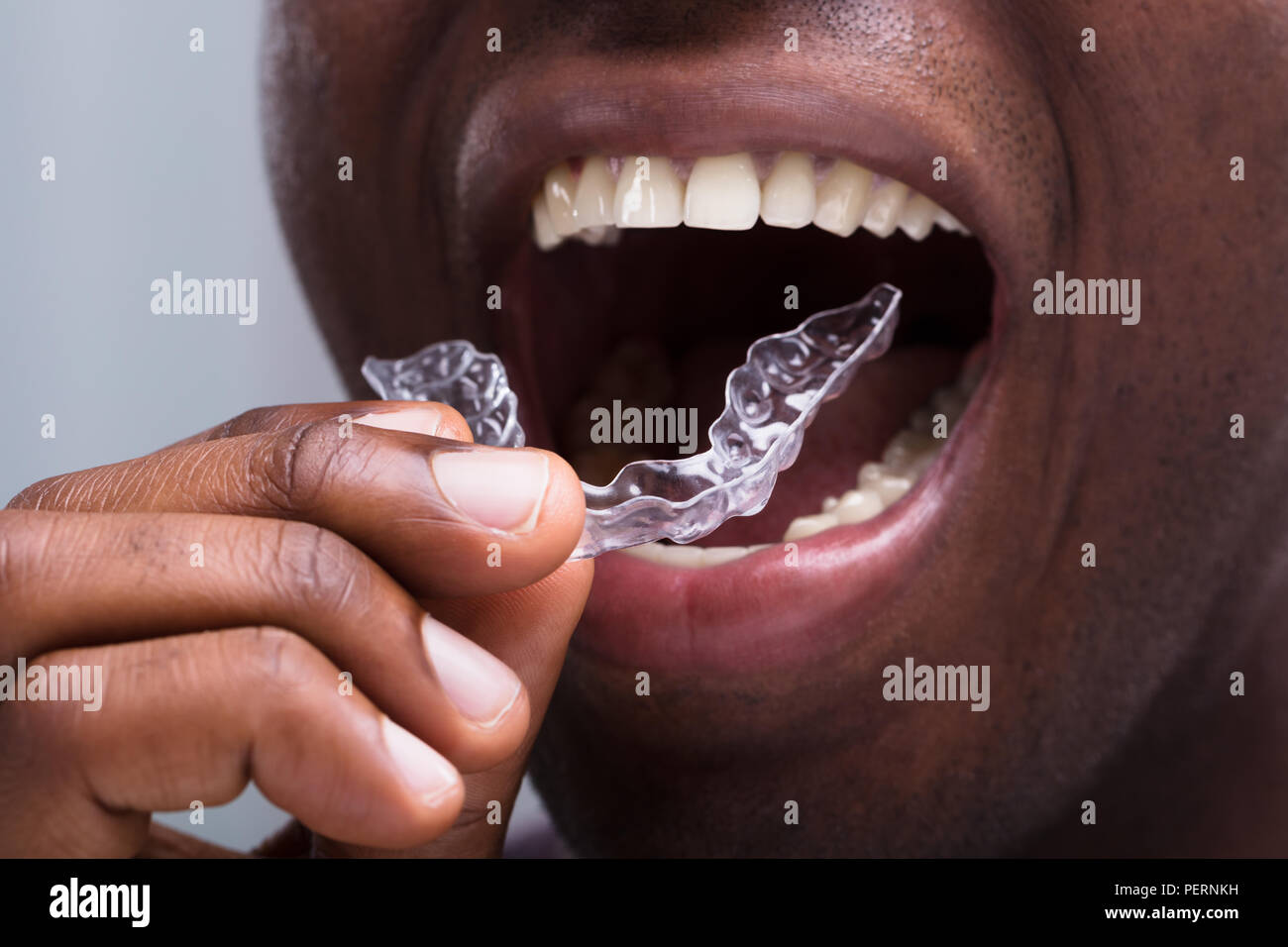 Close-up Of A Man Adjusting Transparent Aligners In His White Teeth ...