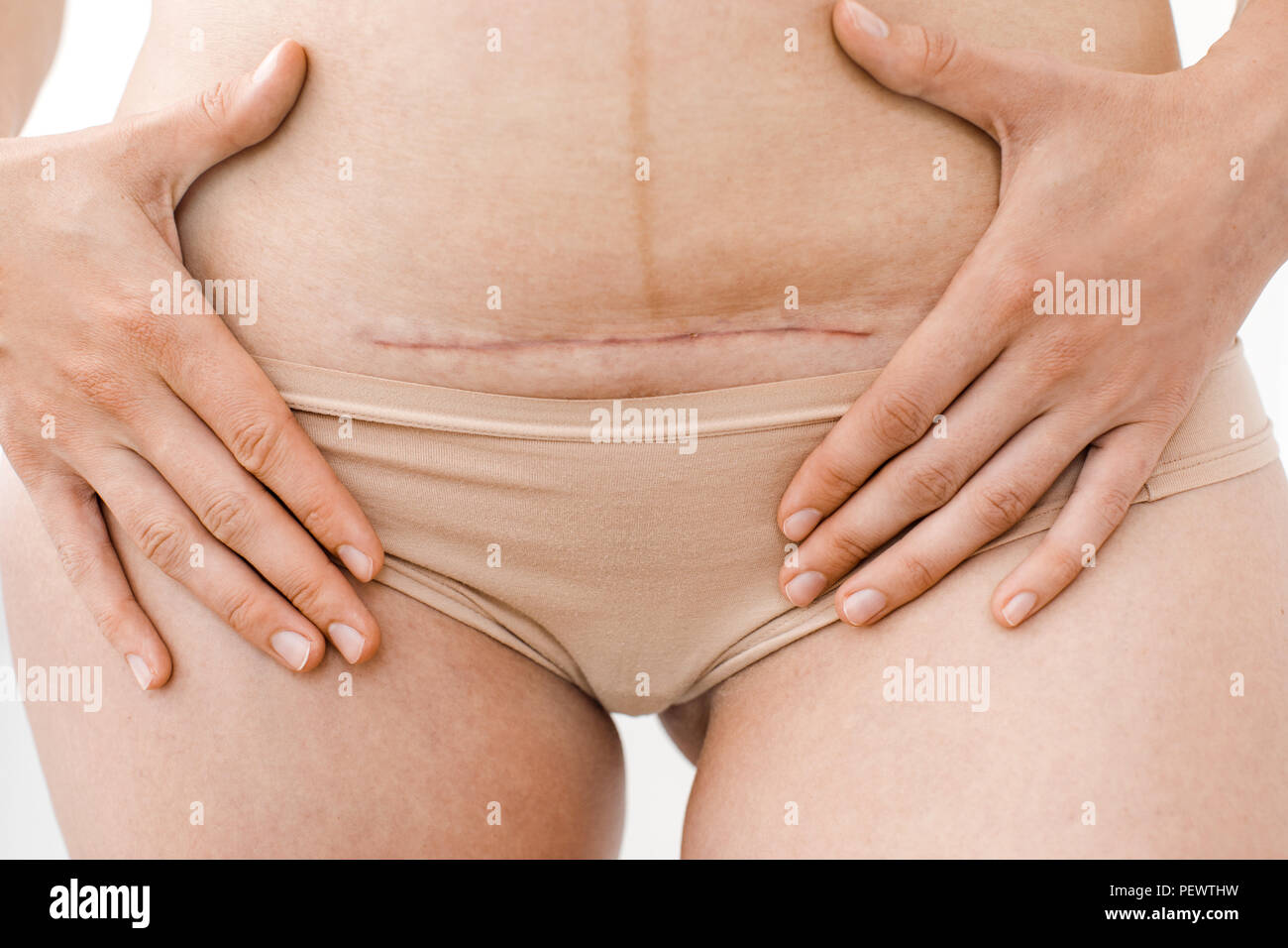 closeup of woman's belly with a scar from a cesarean section Stock Photo
