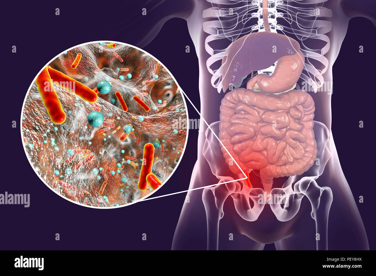 Appendicitis. Illustration of a human appendix, showing it red and inflamed in appendicitis and a close-up view of bacteria, the causative agents of appendicitis. The most common microorganisms recovered from appendix with acute appendicitis are Escherichia coli and Bacteroides sp., the less commonly found are, Klebsiella pneumoniae, Streptococcus sp. Enterococcus sp. Pseudomonas aeruginosa and other bacteria. Stock Photo