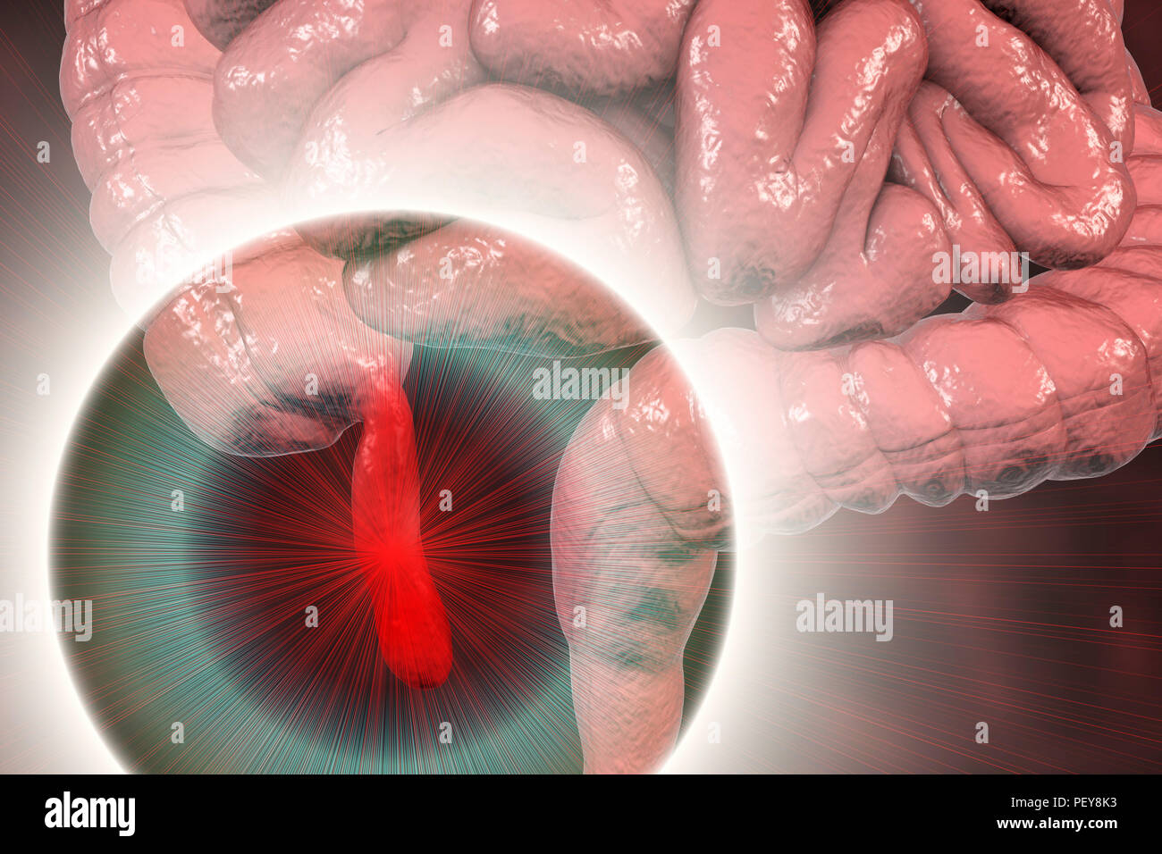 Human Appendix Inflamed