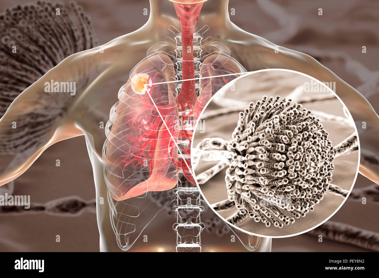 Aspergilloma of the lung and a closeup view of Aspergillus fungi