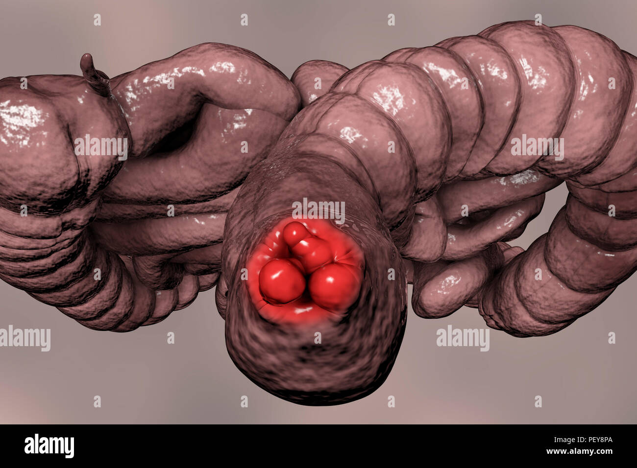 Haemorrhoids. Computer illustration of human intestines from below with haemorrhoids in the anus. Stock Photo
