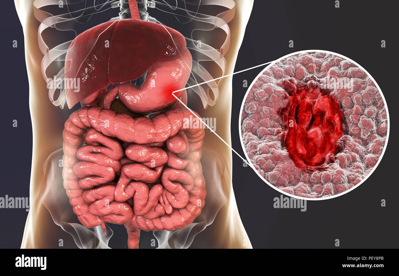 Gastric (stomach) ulcer, illustration. Gastric, or peptic, ulcers are erosions of the mucosal lining of the stomach. Stock Photo