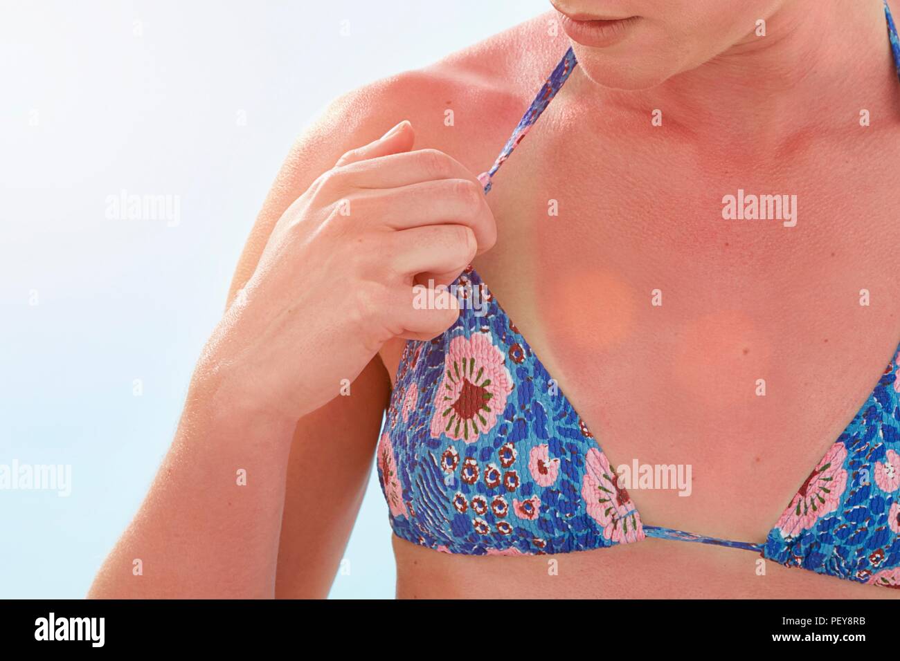 Woman with sunburnt chest. Stock Photo