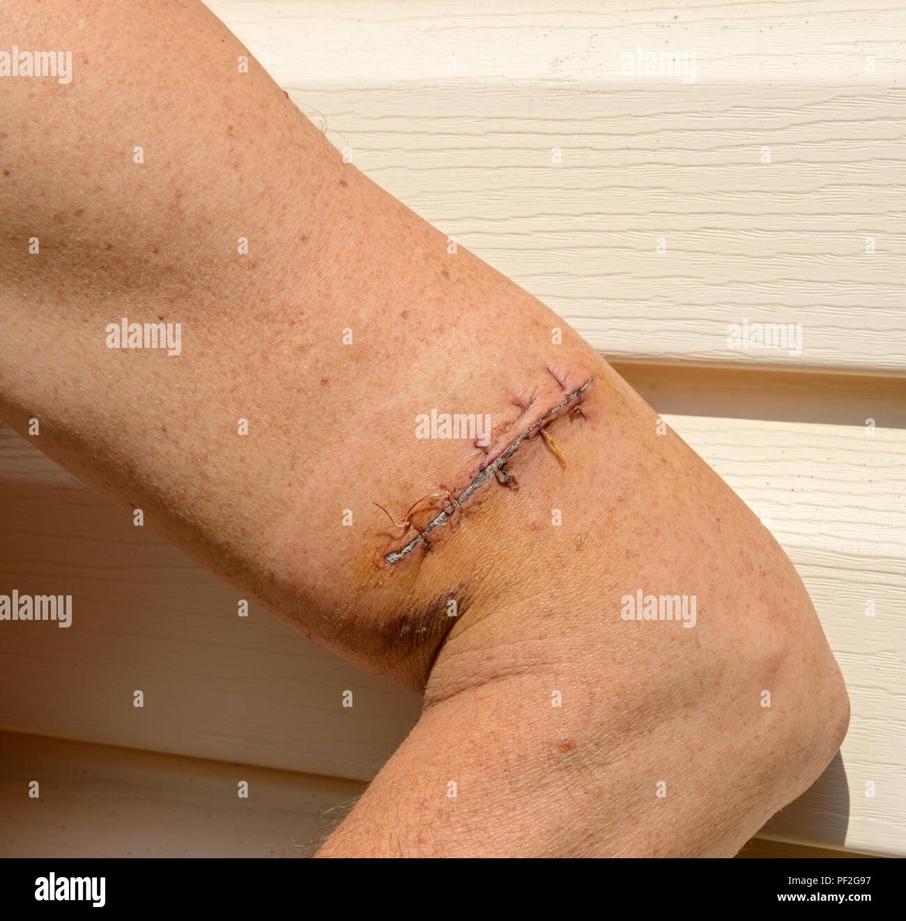 Recent suture of lacerated wound on mature man arm in bright sunlight. Stock Photo