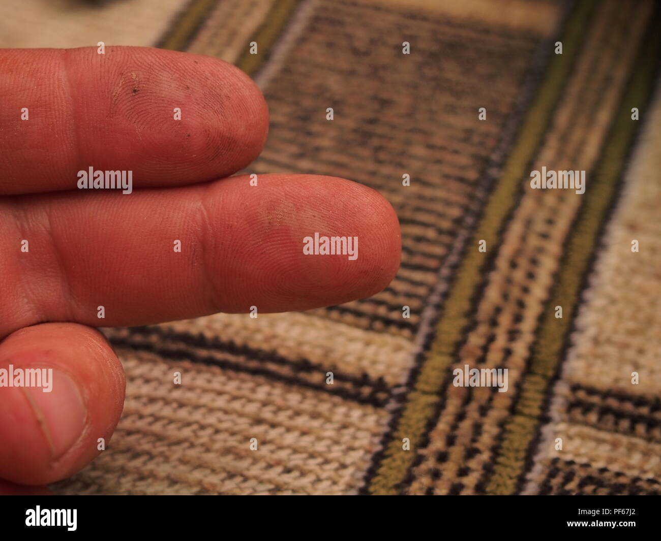 Burns Injury Stock Photos & Burns Injury Stock Images - Alamy