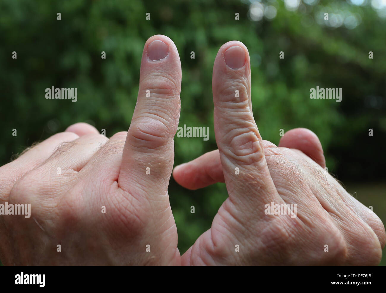Kempten, Germany. 20th Aug, 2018. The little finger of one hand has swollen  after a wasp sting. For comparison, the little finger of the other hand can  be seen. Credit: Karl-Josef Hildenbrand/dpa/Alamy