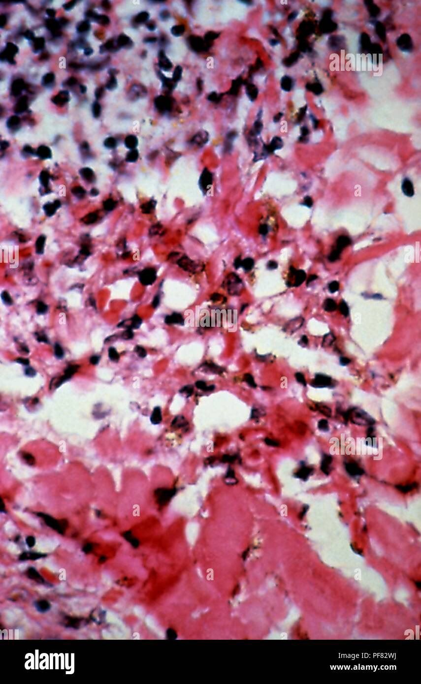 Histopathologic changes found in the case of Kaposi's sarcoma lesions revealed in the skin biopsy micrograph film, 1981. Image courtesy Centers for Disease Control (CDC) / Dr Steve Kraus. () Stock Photo
