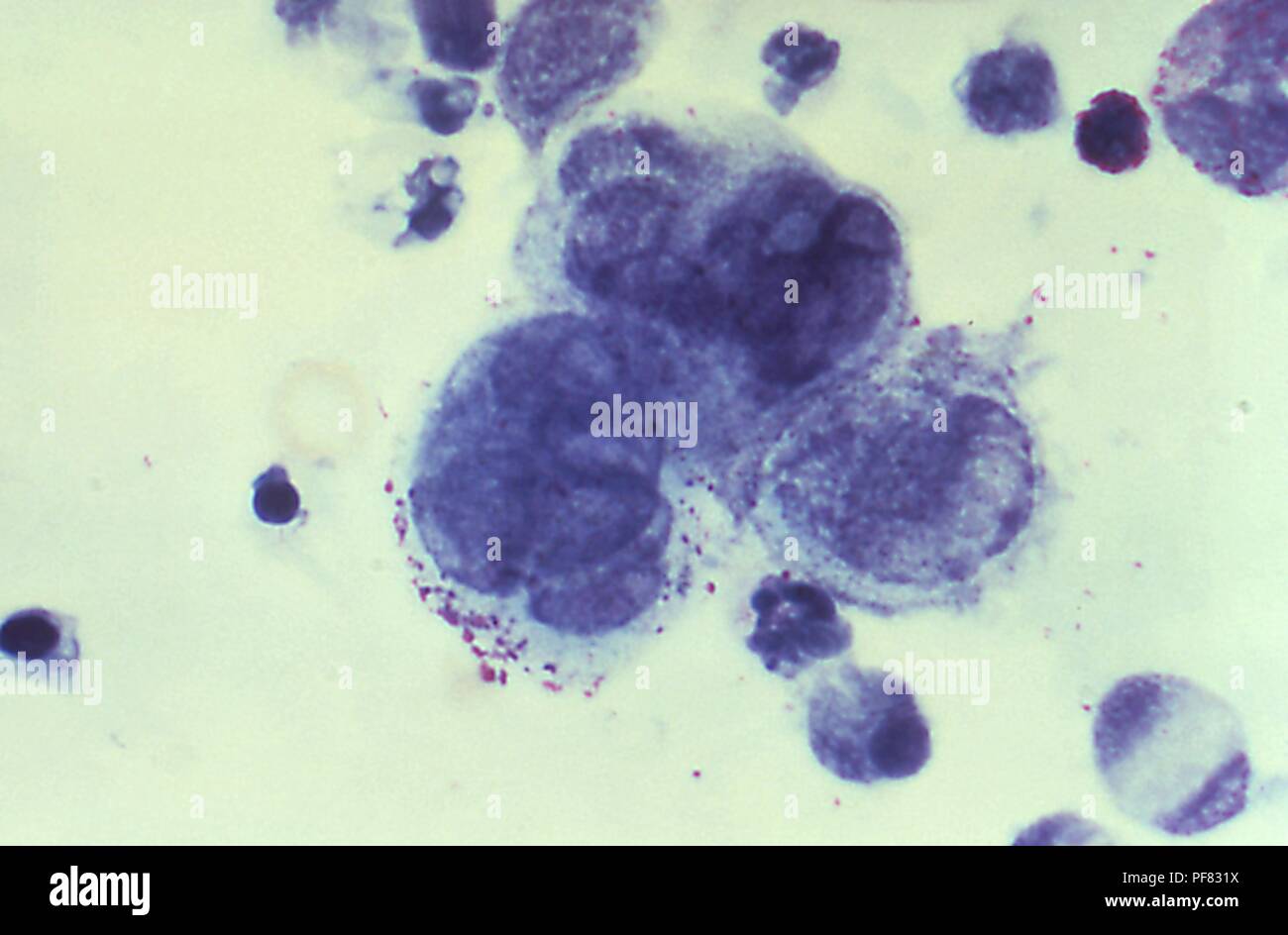 Presence of herpes simplex virus in a Tzanck test specimen revealed in
