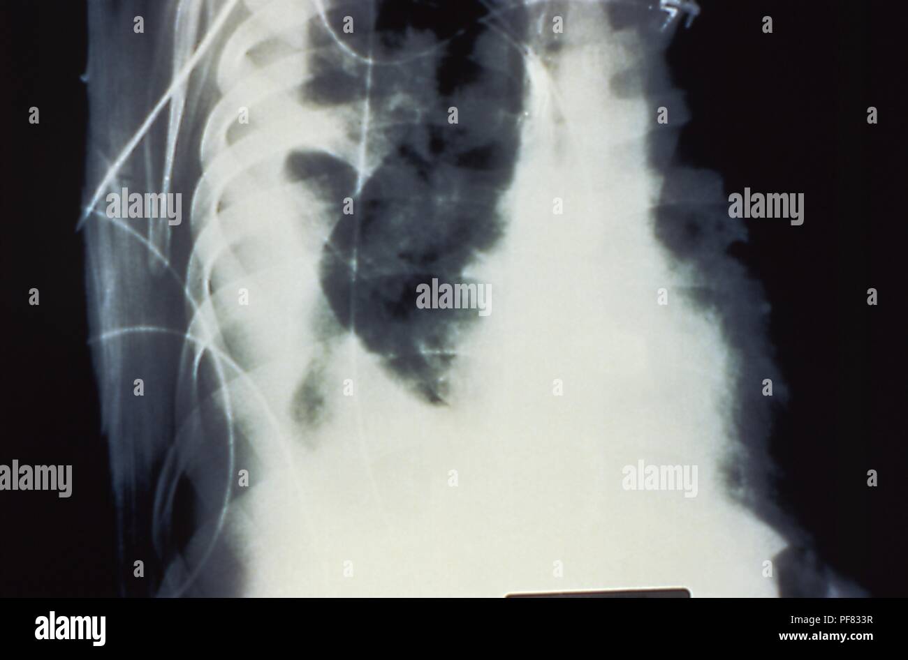Large pulmonary effusion due to hantavirus pulmonary syndrome (HPS), revealed in the lateral decubitus chest x-ray, 1994. Image courtesy Centers for Disease Control (CDC) / D. Loren Ketai, M.D. () Stock Photo