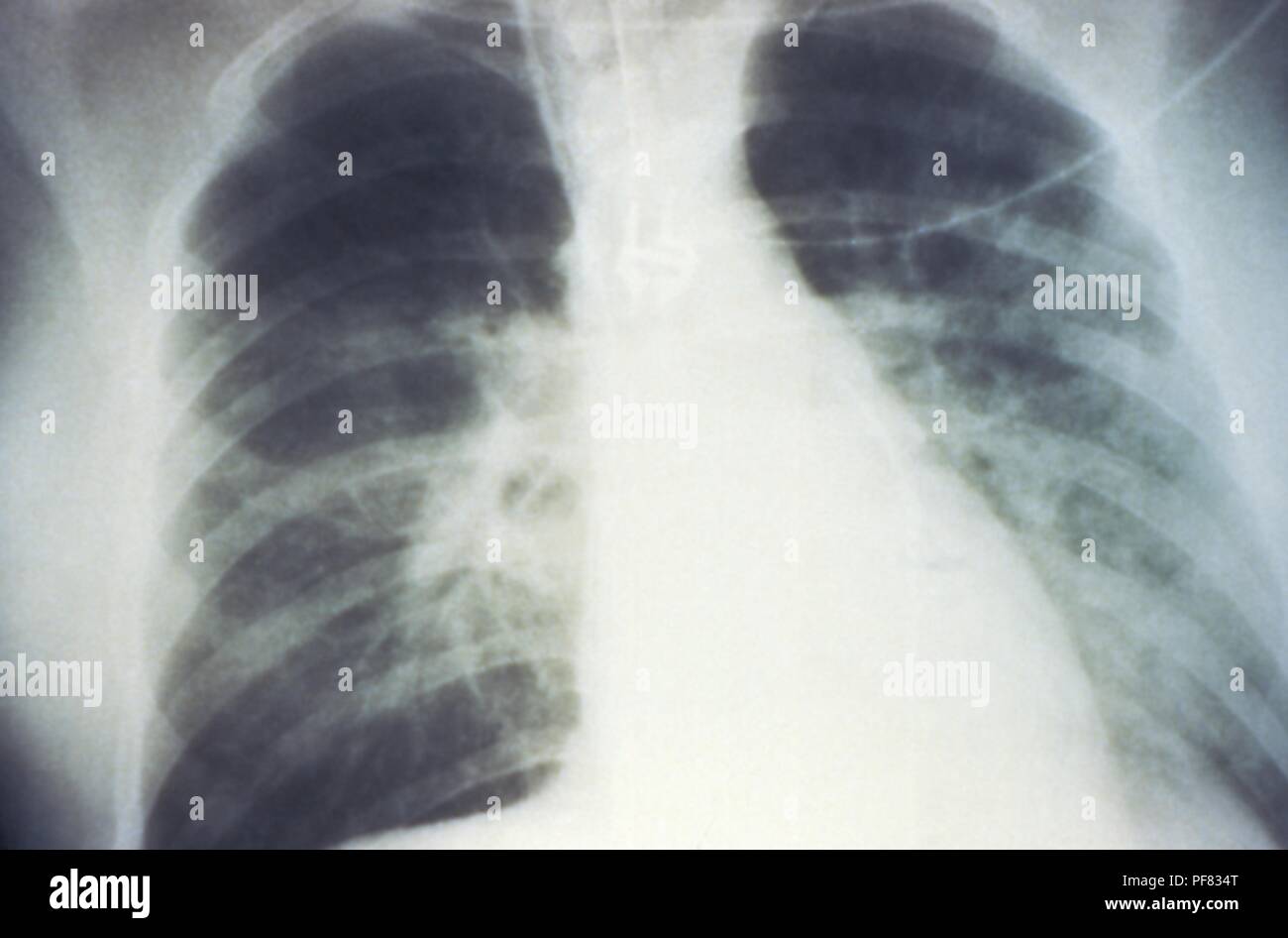 Mid-staged bilateral pulmonary effusion due to Hantavirus pulmonary syndrome (HPS), revealed in the AP chest x-ray, 1994. Image courtesy Centers for Disease Control (CDC) / D. Loren Ketai, M.D. () Stock Photo