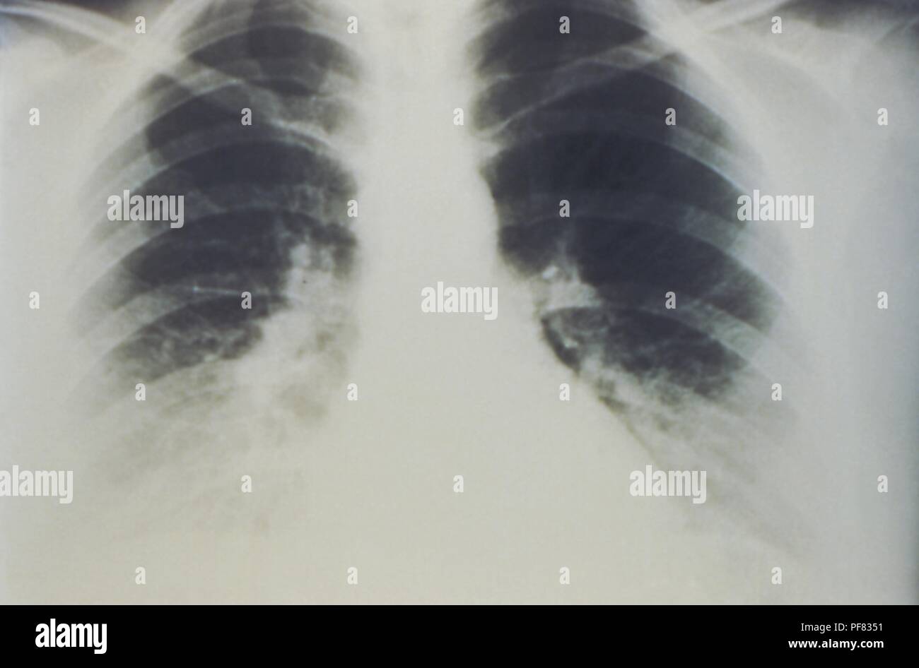 Early stages of bilateral pulmonary effusion due to Hantavirus pulmonary syndrome (HPS), revealed in the AP chest x-ray, 1994. Image courtesy Centers for Disease Control (CDC) / D. Loren Ketai, M.D. () Stock Photo