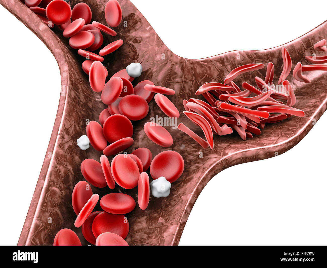 Sickle cell anemia, 3D illustration showing blood vessel with normal