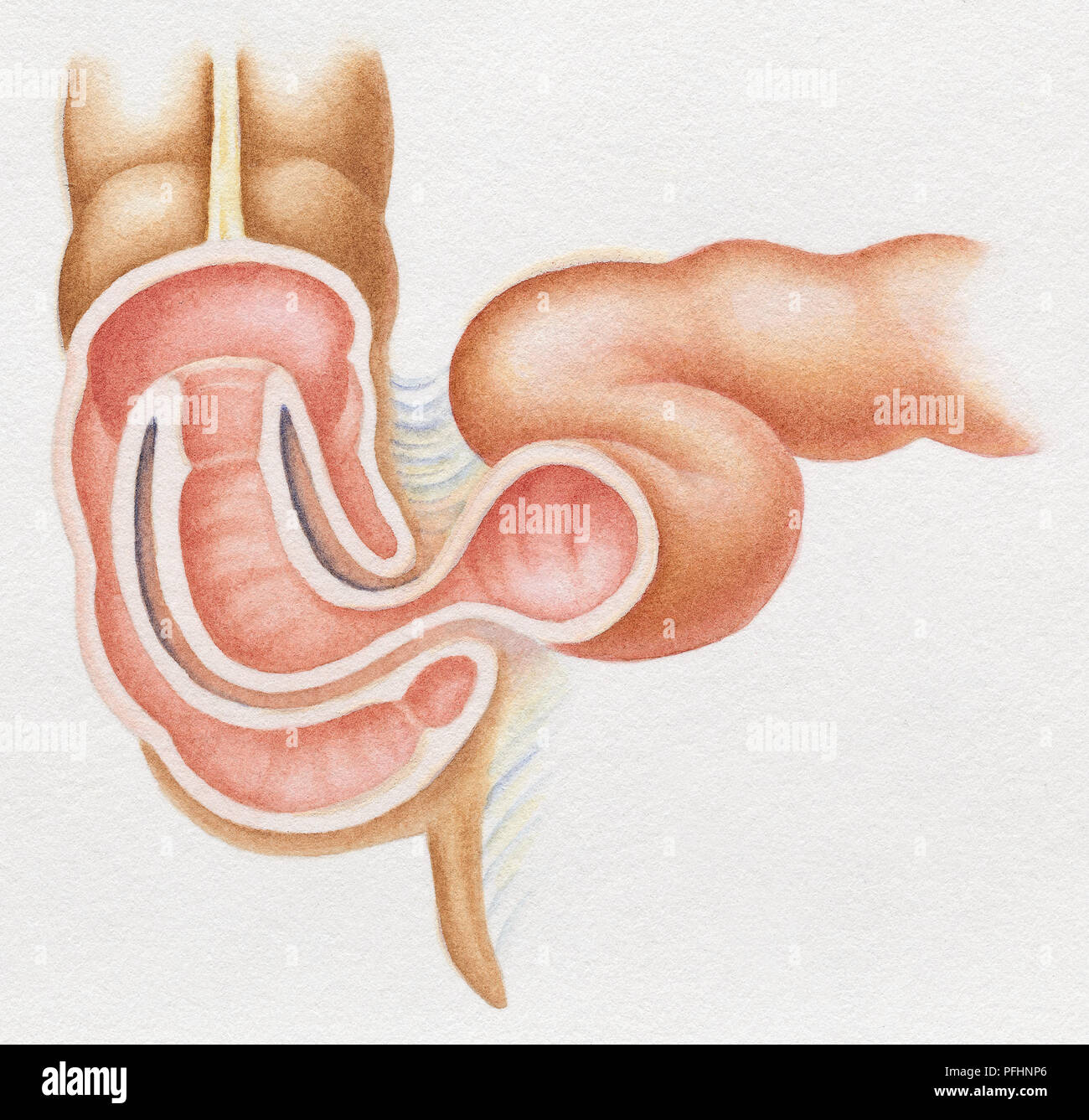 Inglustination Intestinal Intestinal Obstruction Stock Photos & Intestinal Obstruction Stock ...
