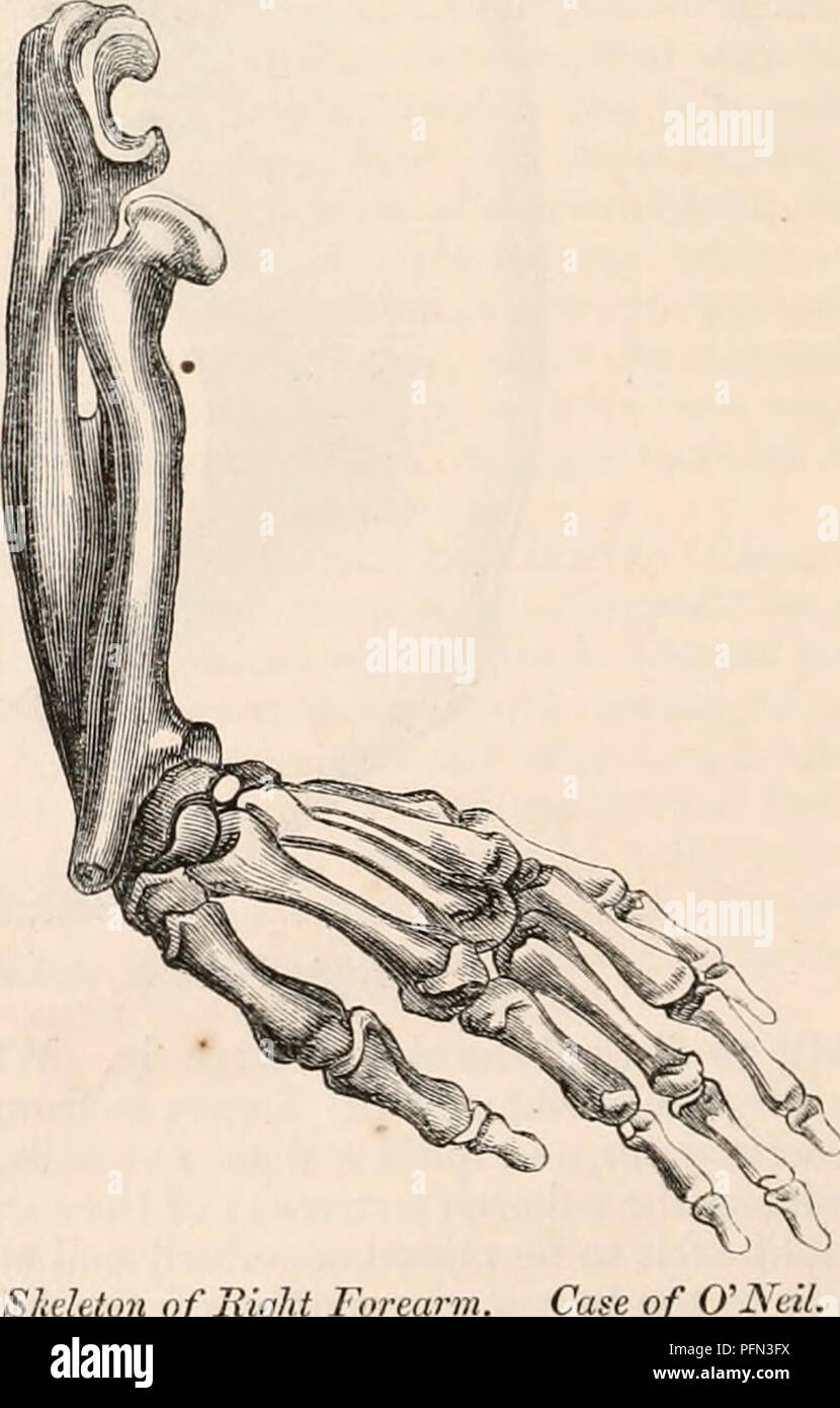 . The cyclopædia of anatomy and physiology. Anatomy; Physiology; Zoology. Left Forearm. Case of O'Neil. It was stated that she never met with any accident, and that the peculiar deformity observable in each forearm and wrist-joint had existed from her birth. The writer, in continuation, observed, that while congenital malformation was known very frequently to affect simultaneously both sides of the body, yet it would, on the other hand, be very difficult for any one to suggest what pro- bable accidental causes could be imagined capable of dislocating the bones of both wrist- joints, in opposit Stock Photo