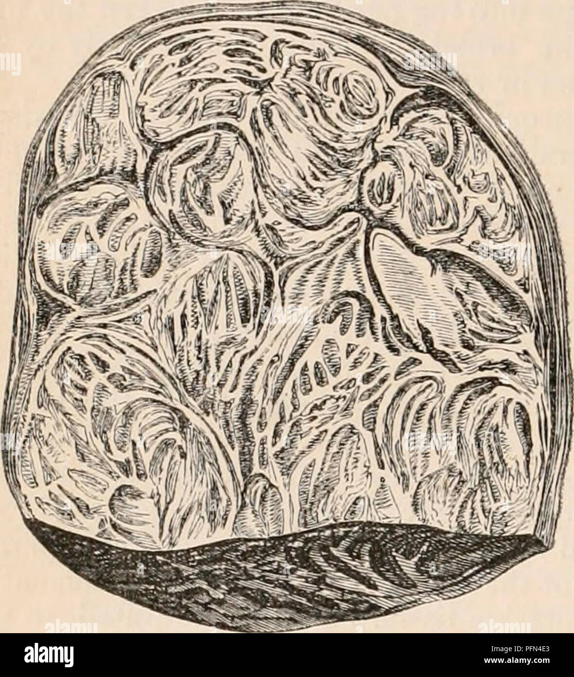 . The cyclopædia of anatomy and physiology. Anatomy; Physiology; Zoology. 690 UTERUS AND ITS APPENDAGES. mass, so that a muscular rather than a fibrous it may be easily detached and turned out of tissue results. A small quantity of clastic its investing capsule (/%. 475 ). fibre is also occasionally found in these ute- rine formations. Fig. 475. Fig. 474-.. Section of fibroid tumour of the uterus. (Ad Nat.) The structural variations observable in fibroid of the uterus, are dependent chiefly upon the peculiarities in arrangement of these component elements. In the more dense formations, the whi Stock Photo