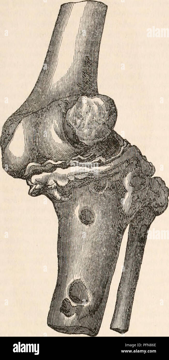 . The cyclopædia of anatomy and physiology. Anatomy; Physiology; Zoology. ABNORMAL CONDITIONS OF THE KNEE-JOINT. Fig. 8. Fig. 9. 67. Femur displaced inwards. Patella anckyksed. elongated and was directed backwards. The crucial ligaments were also elongated, and instead of crossing each other were untwisted as it were and lay side by side. The carti- lages were altogether removed, and when the femur was forcibly separated from the tibia, there were corresponding elevations and de- pressions which marked the several points of contact between the bones, in which a species of anchylosis had occurr Stock Photo