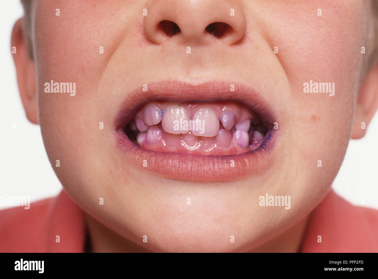 Teeth plaque dye hires stock photography and images Alamy