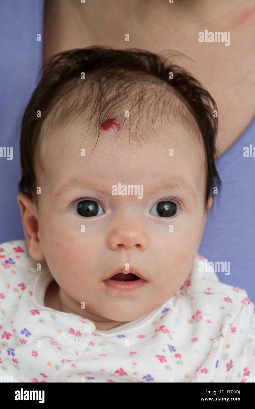 Portrait of baby girl with birthmark on forehead Stock Photo