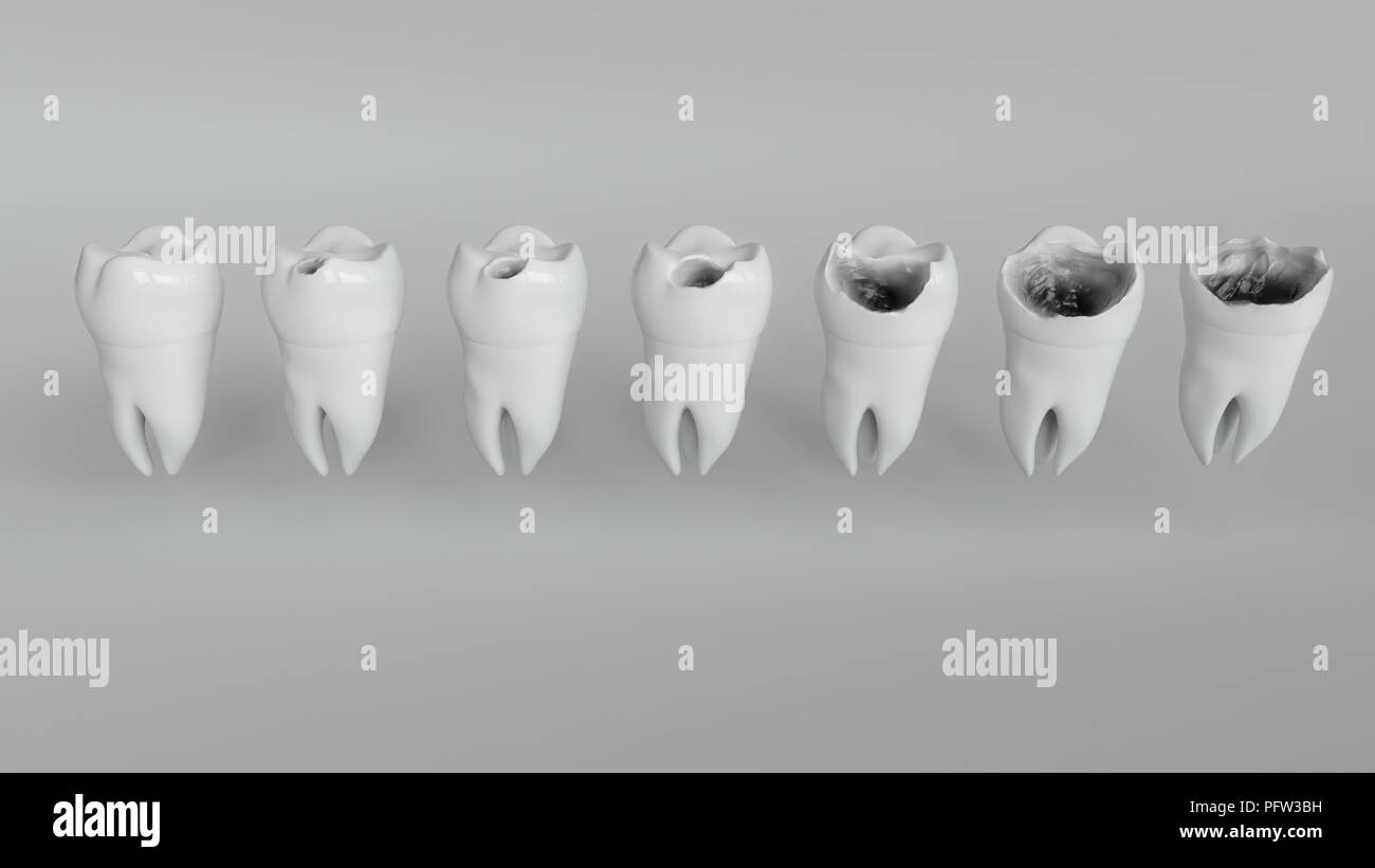 The stages of caries on the molar - 3D Rendering Stock Photo